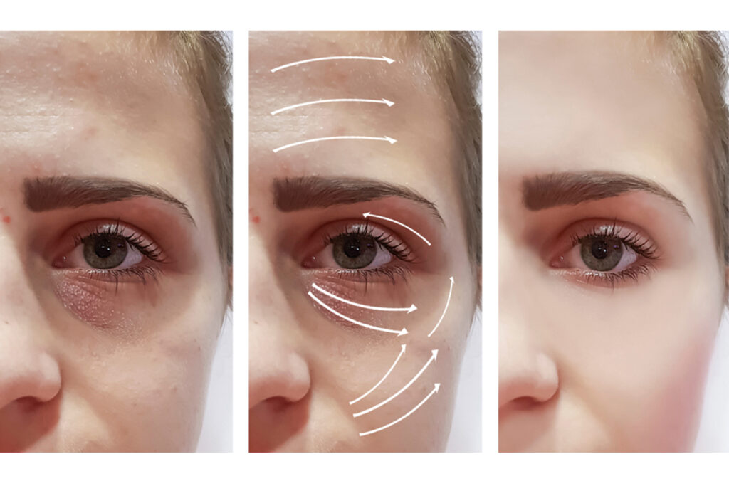 3 Ways Botox Can Rejuvenate Your Face Above the Mask