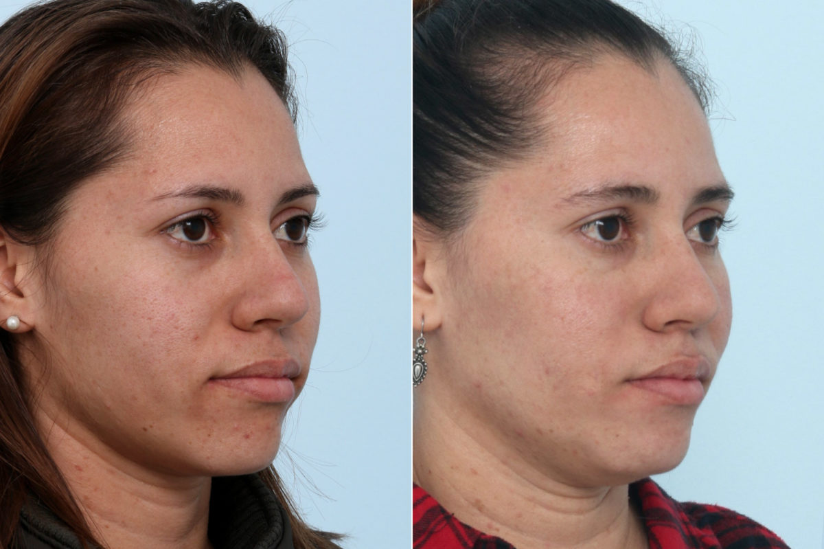 Fraxel Laser Before and After Photos in Houston, TX, Patient 10837