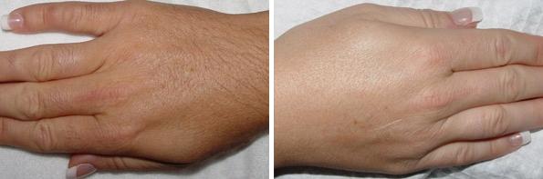 1736358926 patient 8036 laser hair removal before after
