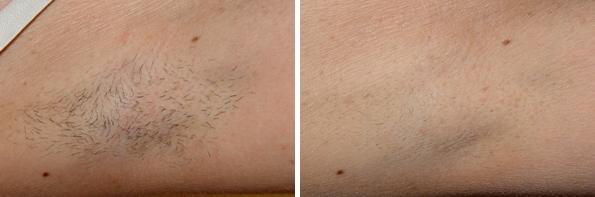 1736358929 patient 8036 laser hair removal before after 6