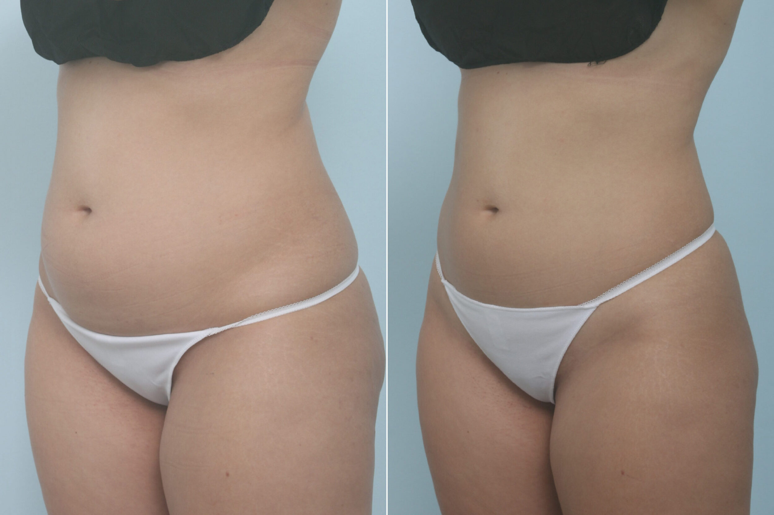Before and After Image: CoolSculpting Before and After Photos in Houston, TX, Patient 11357 - left-front-oblique