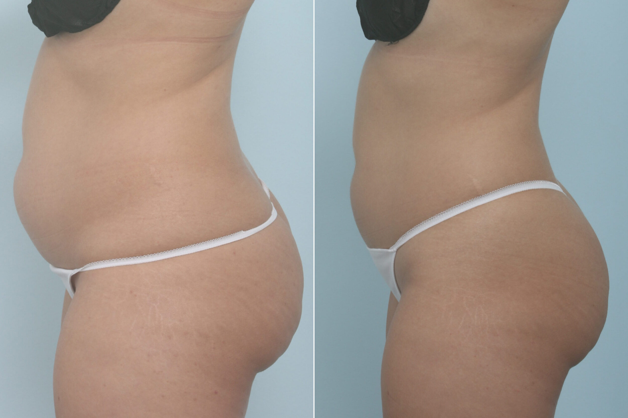 Before and After Image: CoolSculpting Before and After Photos in Houston, TX, Patient 11357 - left-side