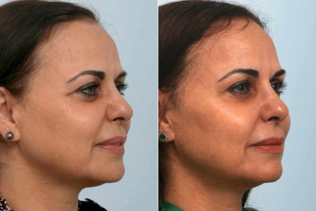 Before & After Patient Photos | Neck Rejuvenation Houston, TX | Mirror Mirror Beauty Boutique
