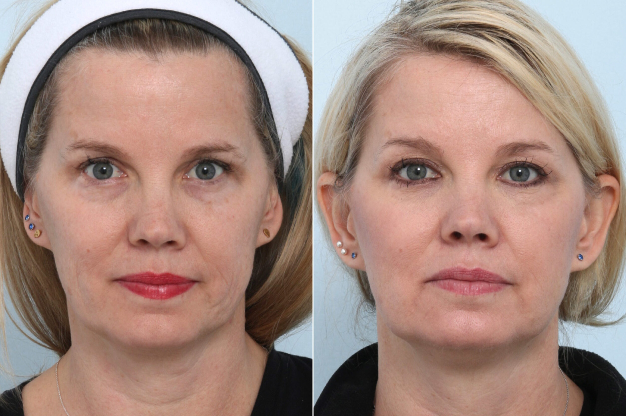 Before and After Image: Ulthera Lift Before and After Photos in Houston, TX, Patient 11582 - front