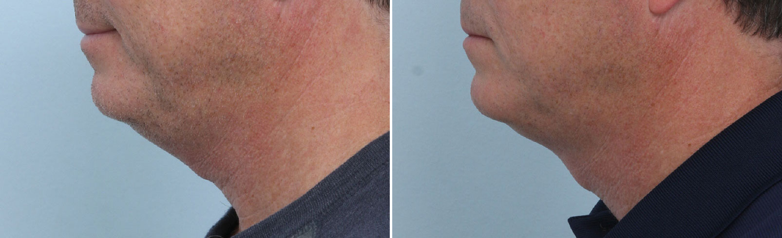 Before and After Image: CoolSculpting Before and After Photos in Houston, TX, Patient 14002 - left-side