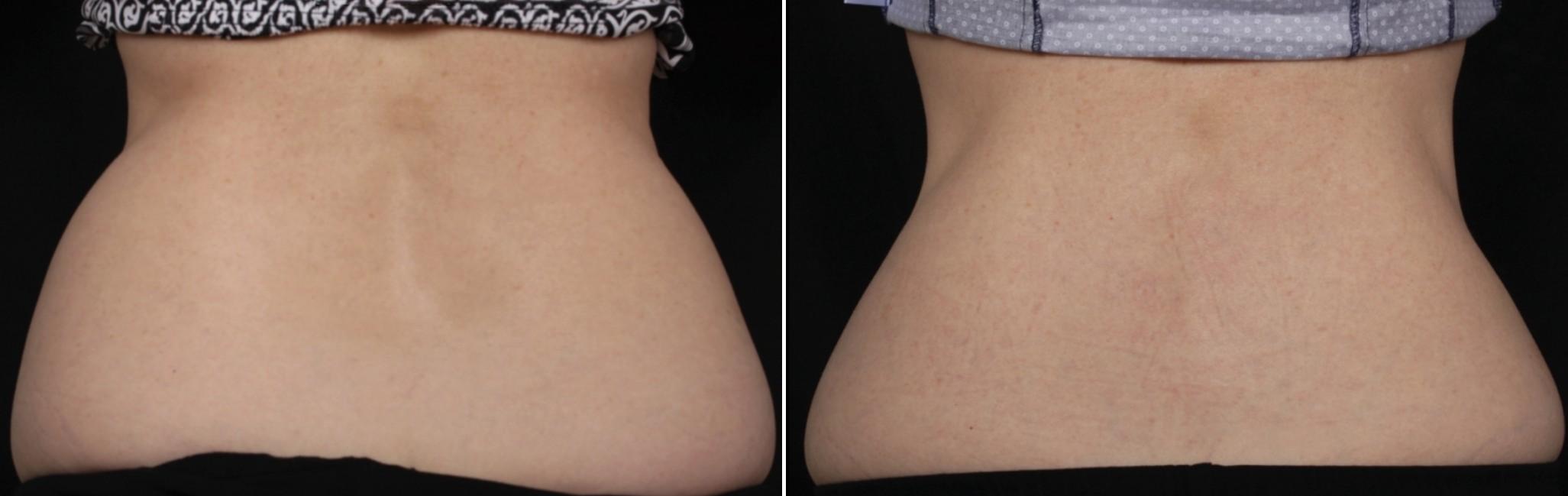 Before and After Image: CoolSculpting Before and After Photos in Houston, TX, Patient 7811 - back