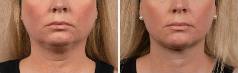 Before and After Image: CoolSculpting Before and After Photos in Houston, TX, Patient 7865 - front