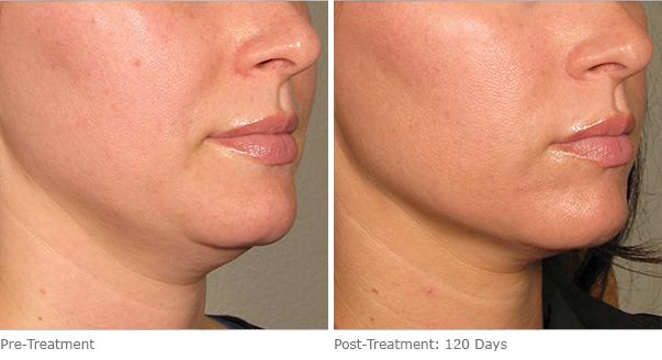 Before and After Image: Ulthera Lift Before and After Photos in Houston, TX, Patient 8265 - right-front-oblique