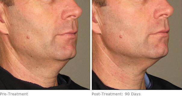 Before and After Image: Ulthera Lift Before and After Photos in Houston, TX, Patient 8256 - right-front-oblique