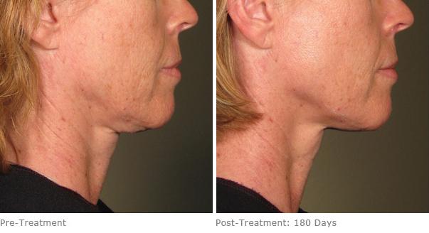 Before and After Image: Ulthera Lift Before and After Photos in Houston, TX, Patient 8259 - right-side