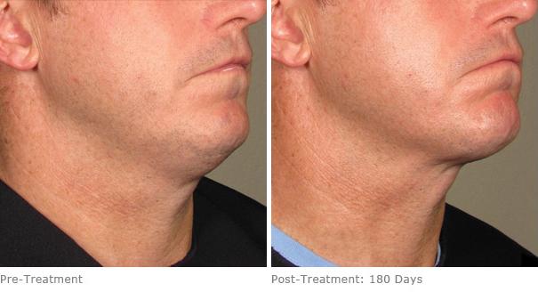 Before and After Image: Ulthera Lift Before and After Photos in Houston, TX, Patient 8262 - right-front-oblique