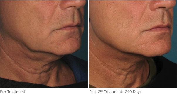 Before and After Image: Ulthera Lift Before and After Photos in Houston, TX, Patient 8299 - right-front-oblique