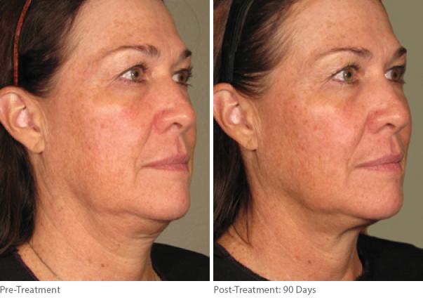 Before and After Image: Ulthera Lift Before and After Photos in Houston, TX, Patient 8279 - front
