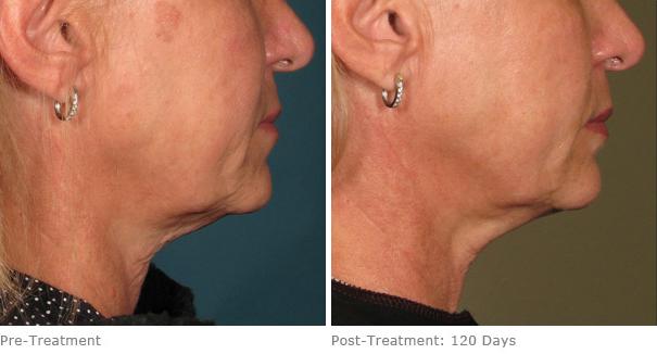 Before and After Image: Ulthera Lift Before and After Photos in Houston, TX, Patient 8337 - right-side