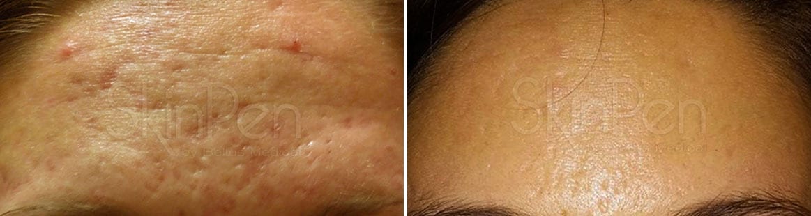 Before and After Image: SkinPen® Microneedling Before and After Photos in Houston, TX, Patient 13705 - front