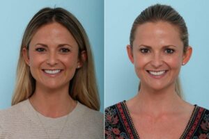 botox cosmetic 1