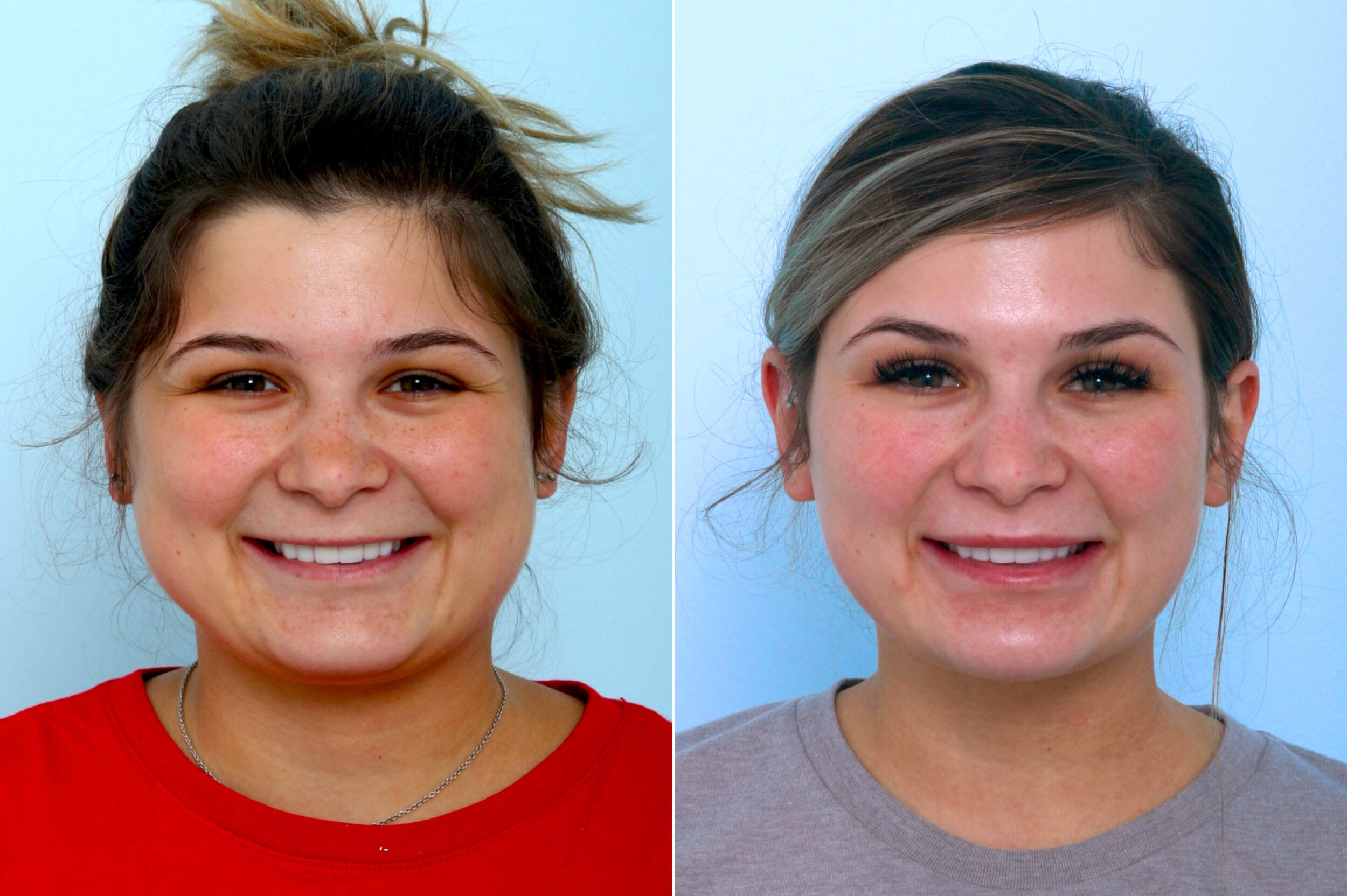 Before and After Image: Botox® Cosmetic & Xeomin Before and After Photos in Houston, TX, Patient 10304 - 