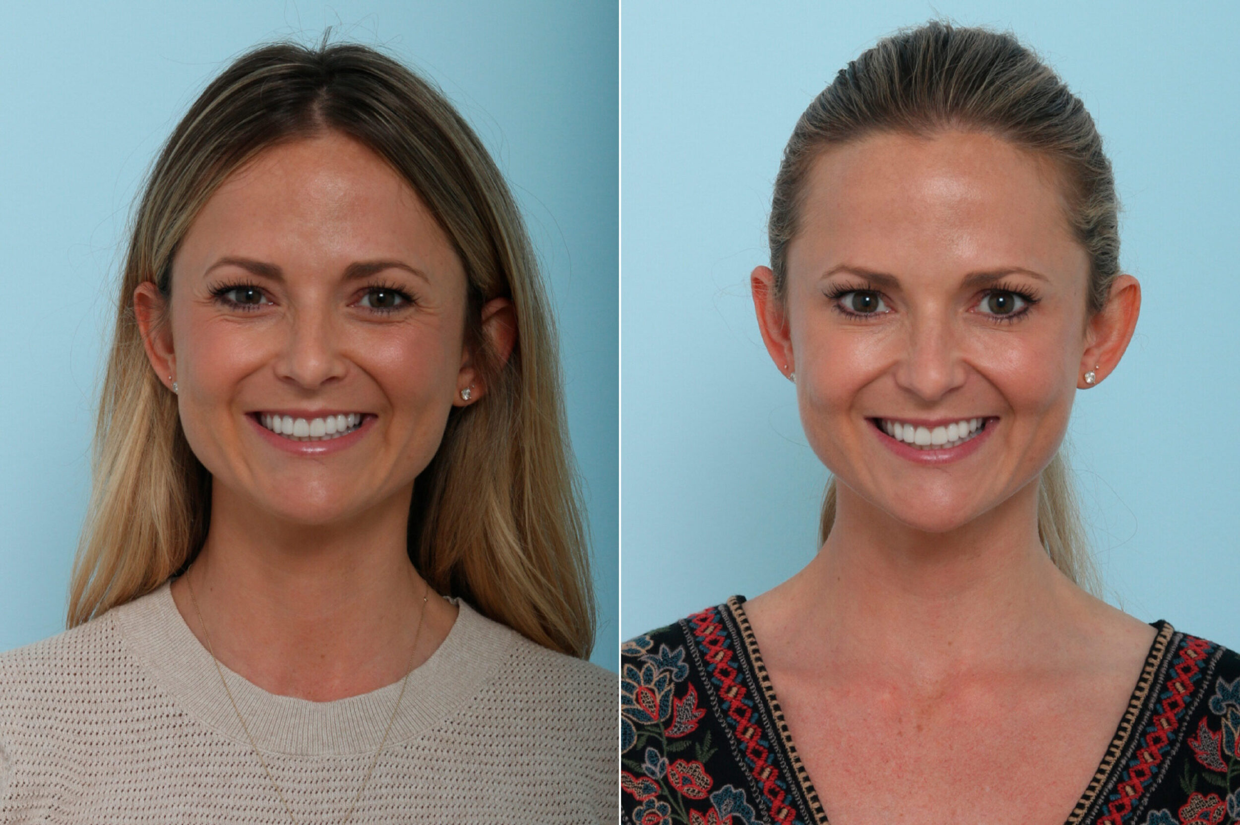 Before and After Image: Botox® Cosmetic & Xeomin Before and After Photos in Houston, TX, Patient 9401 - 
