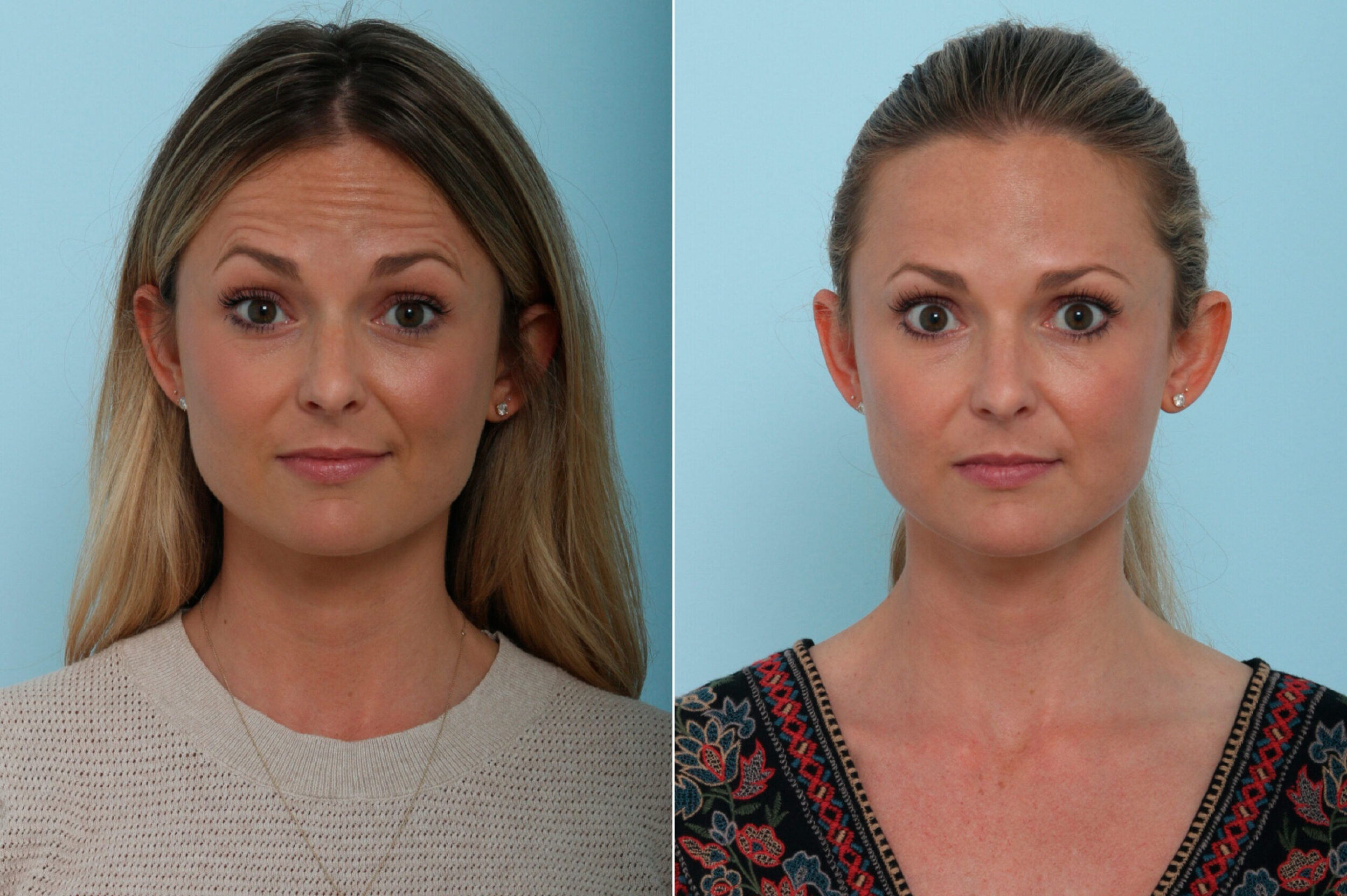 Before and After Image: Botox® Cosmetic & Xeomin Before and After Photos in Houston, TX, Patient 9401 - 