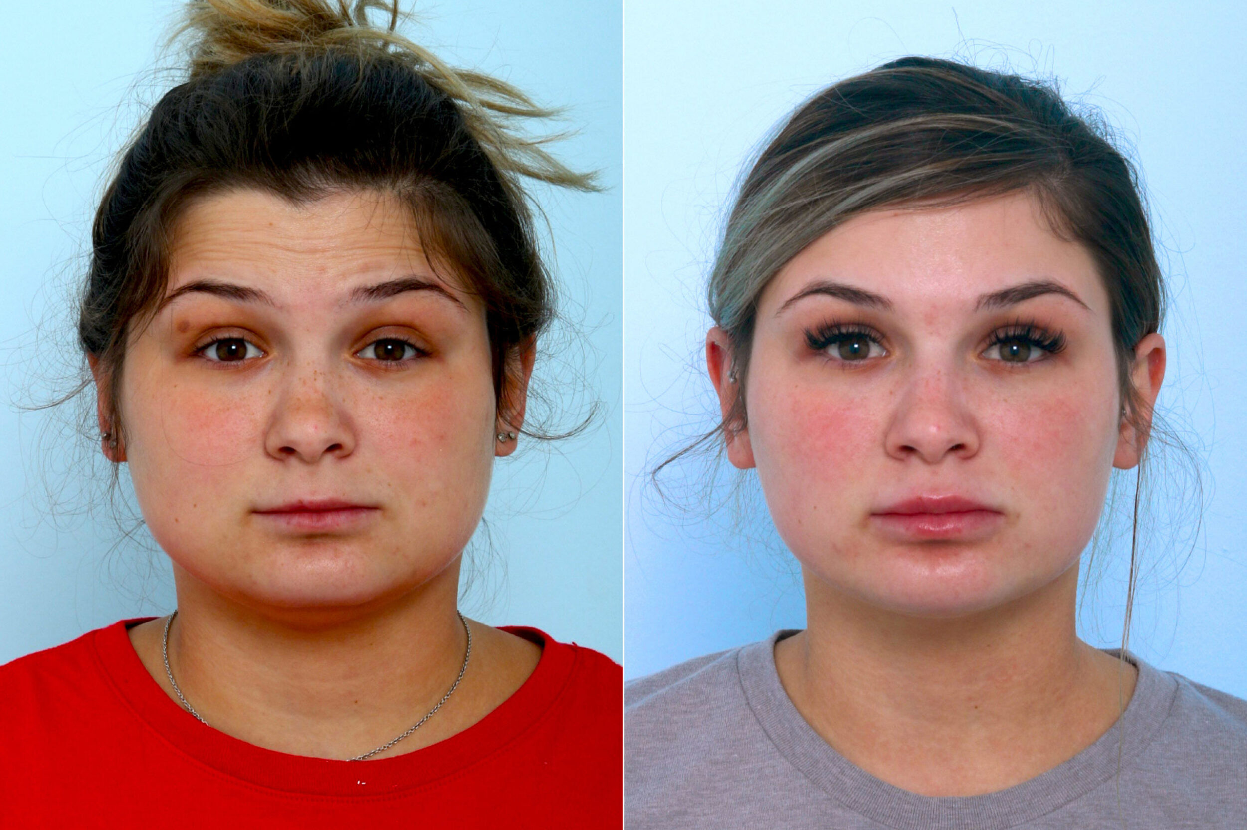 Before and After Image: Botox® Cosmetic & Xeomin Before and After Photos in Houston, TX, Patient 10304 - front