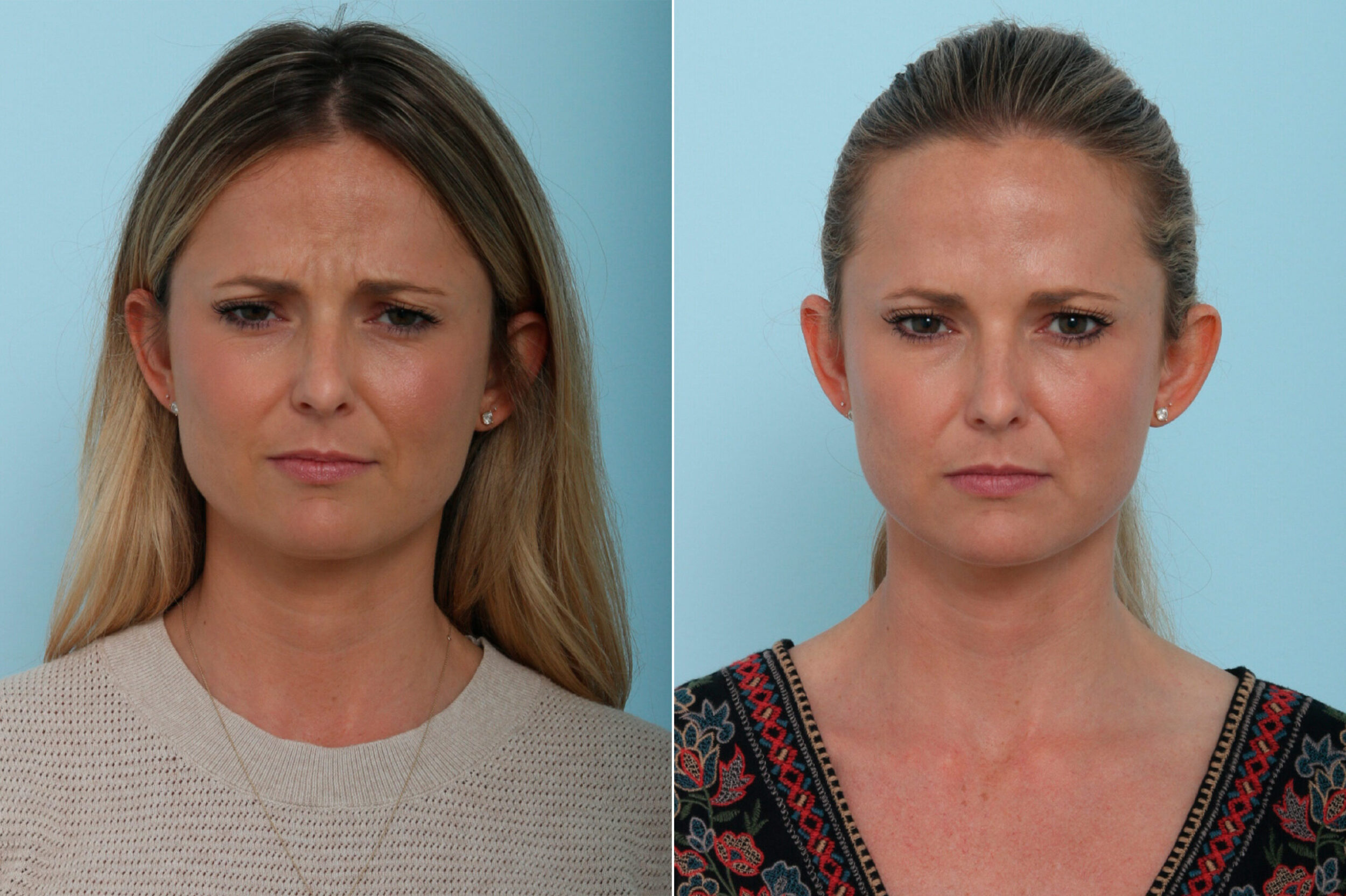 Before and After Image: Botox® Cosmetic & Xeomin Before and After Photos in Houston, TX, Patient 9401 - front
