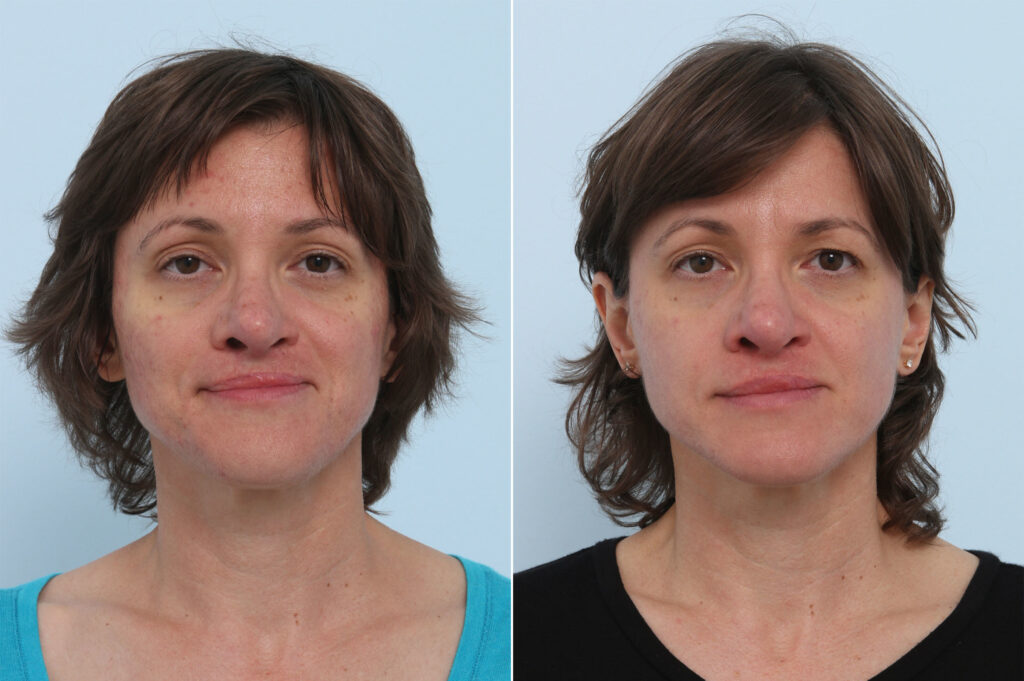 chemical peels before after