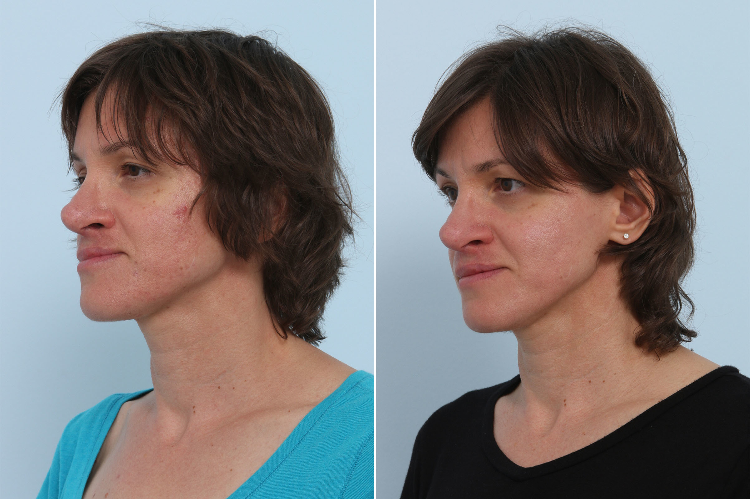 Before and After Image: Chemical Peels Before and After Photos in Houston, TX, Patient 10226 - left-front-oblique