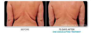 coolsculpting before after 1