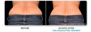 coolsculpting before after 2