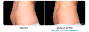 coolsculpting before after 3