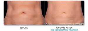 coolsculpting before after 4