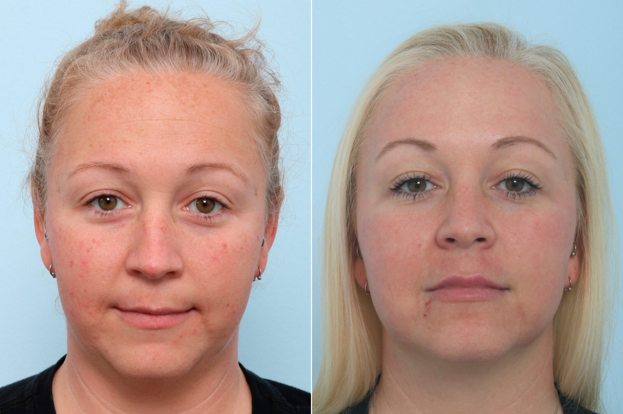 Before and After Image: Fraxel Laser Before and After Photos in Houston, TX, Patient 9770 - front