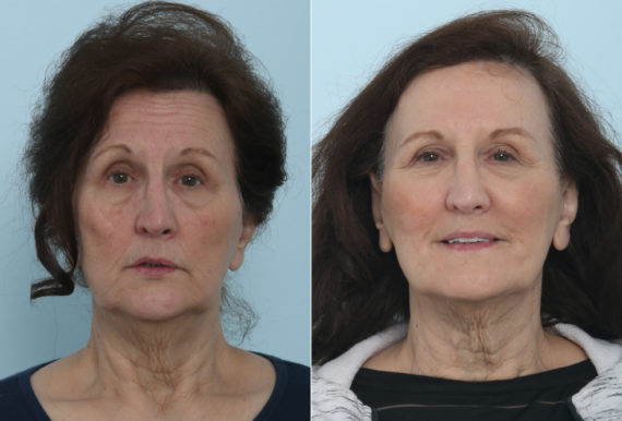 juvederm injectable gel before after 570x386