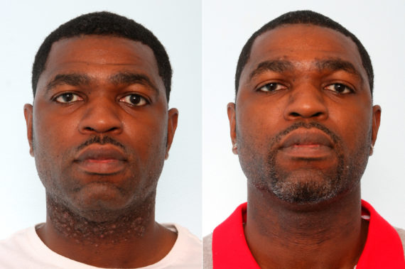 laser hair removal before after 570x379