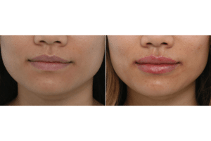 lip enhancement 4
