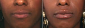 lip enhancement before after scaled