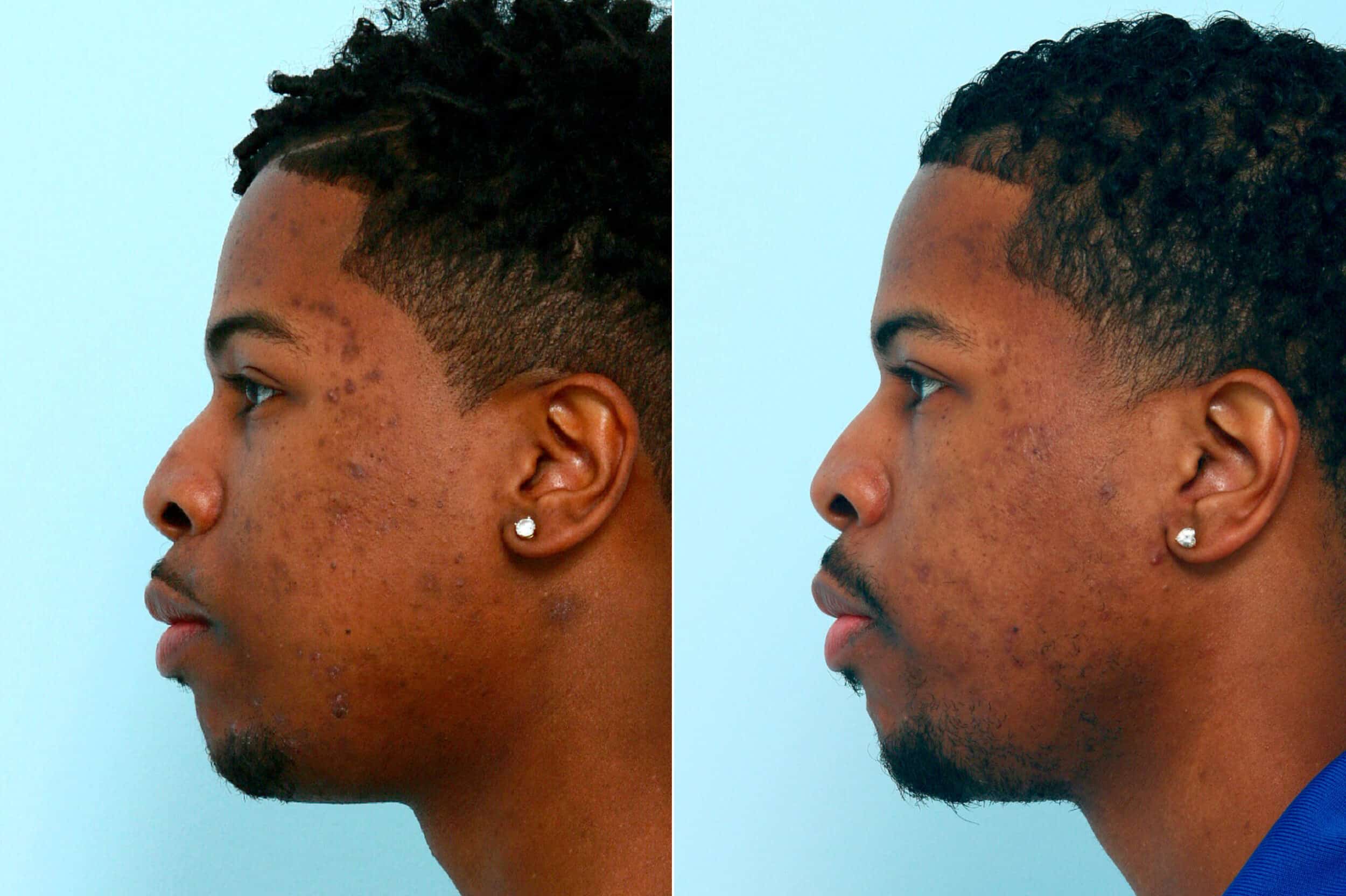Before and After Image: Chemical Peels Before and After Photos in Houston, TX, Patient 10061 - left-side