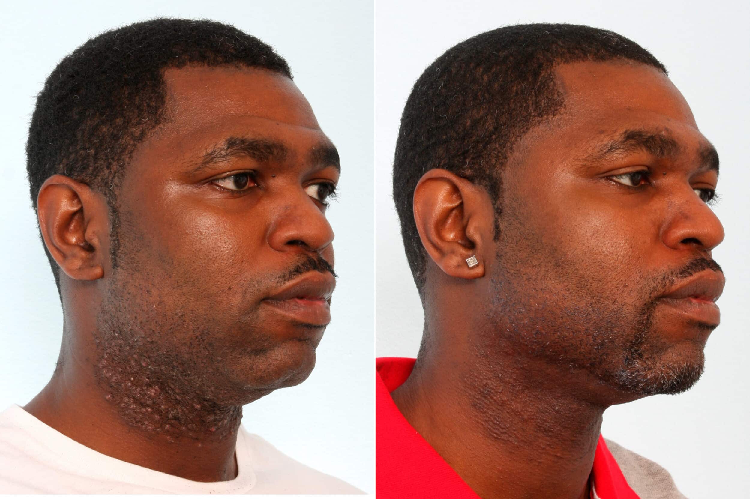 Before and After Image: Laser Hair Removal Before and After Photos in Houston, TX, Patient 10171 - right-front-oblique