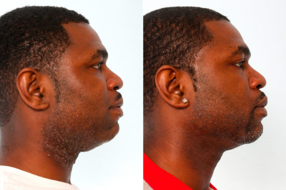 patient 10171 laser hair removal before after 570x379
