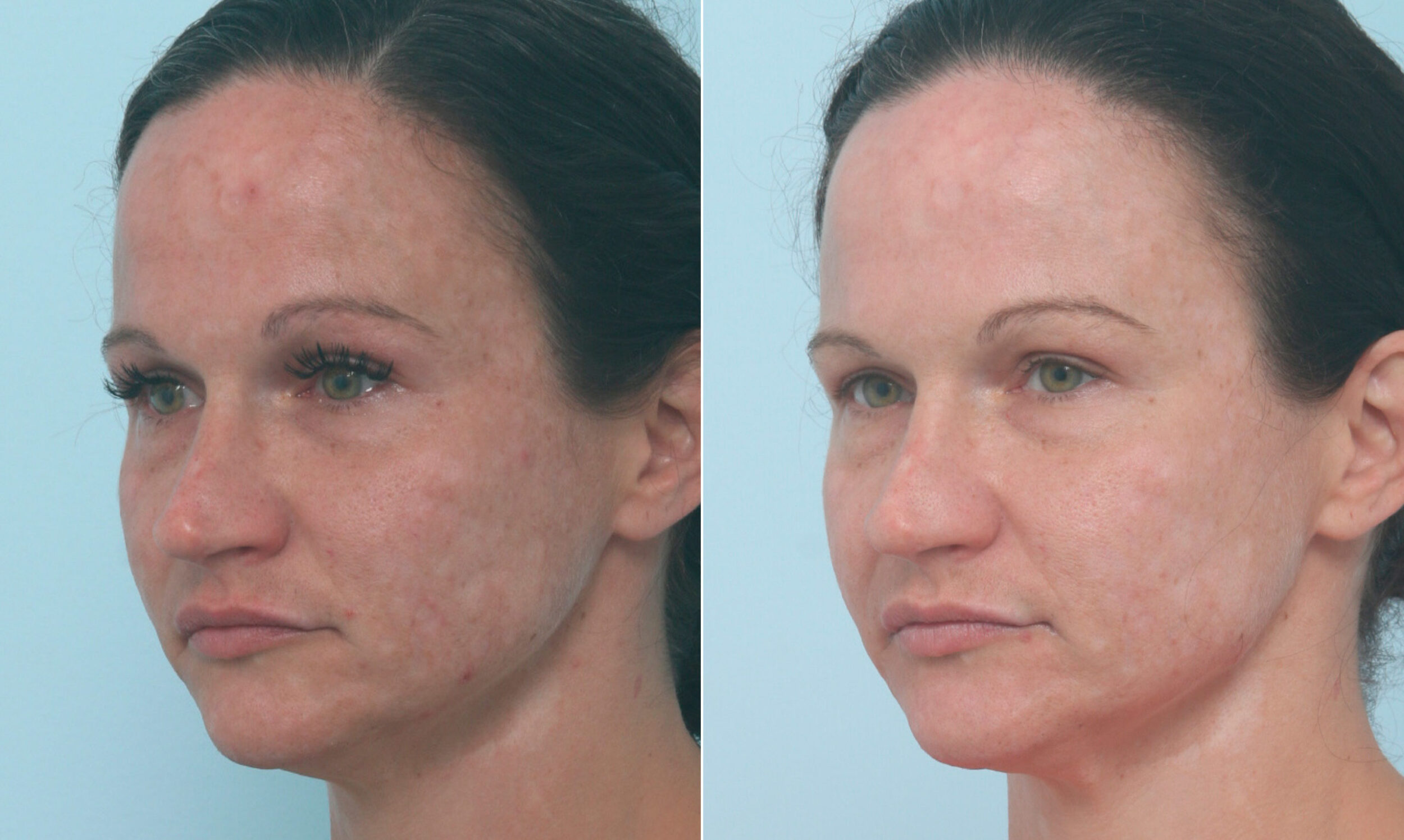 Before and After Image: Fraxel Laser Before and After Photos in Houston, TX, Patient 10321 - left-front-oblique
