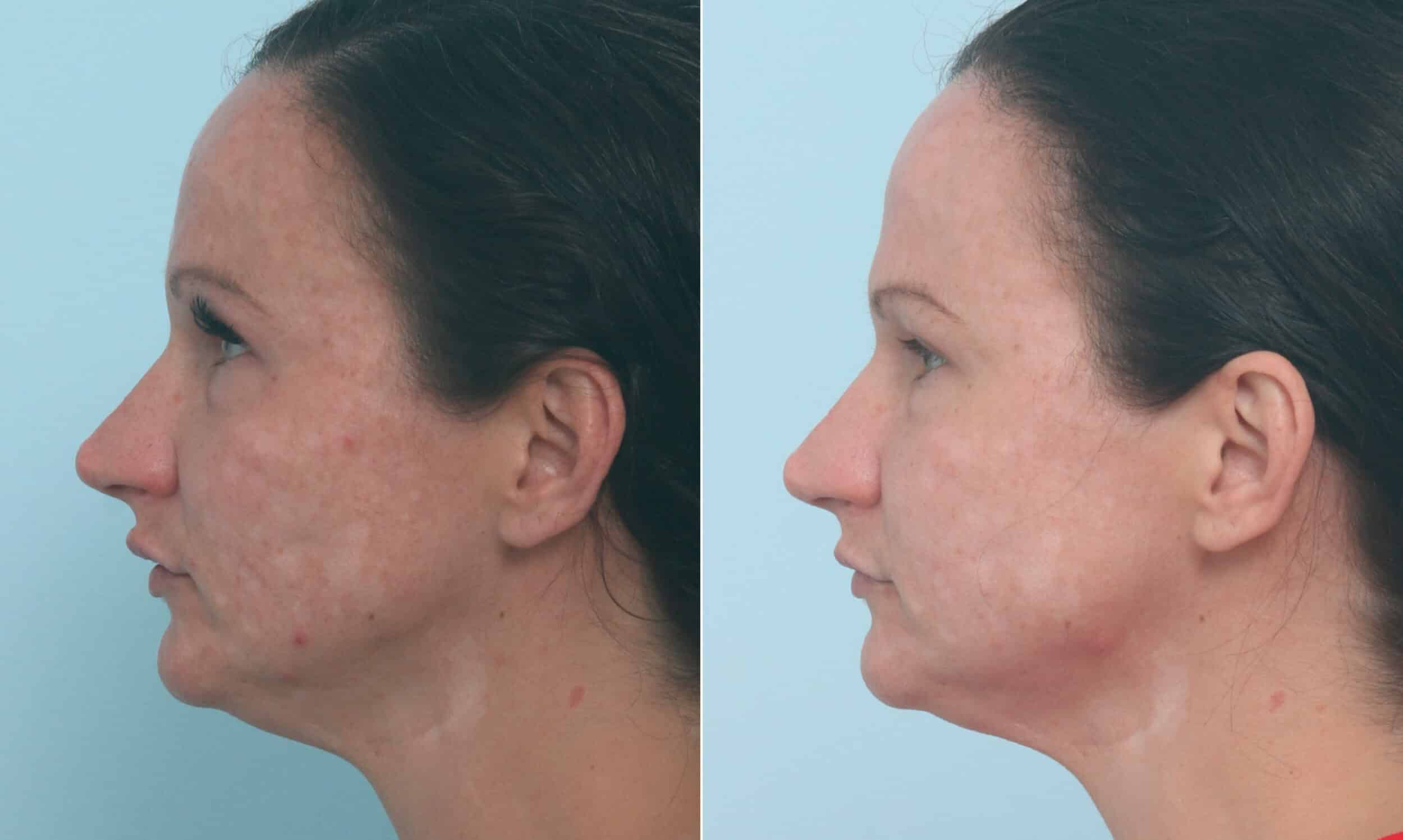 Before and After Image: Fraxel Laser Before and After Photos in Houston, TX, Patient 10321 - left-side