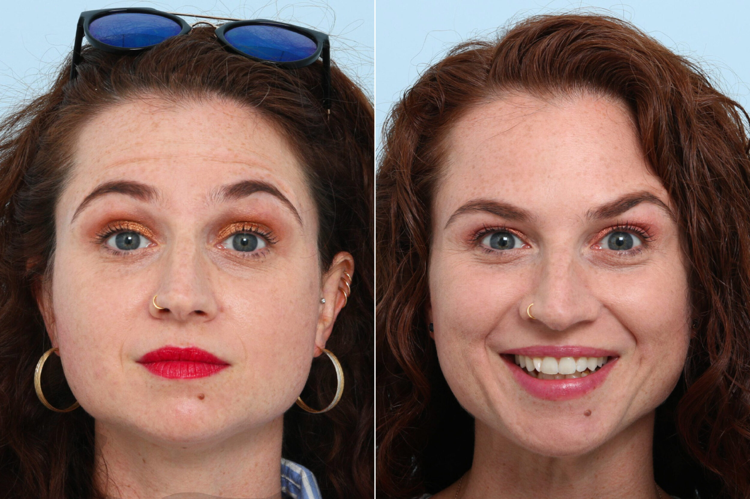 Before and After Image: Botox® Cosmetic & Xeomin Before and After Photos in Houston, TX, Patient 10367 - 