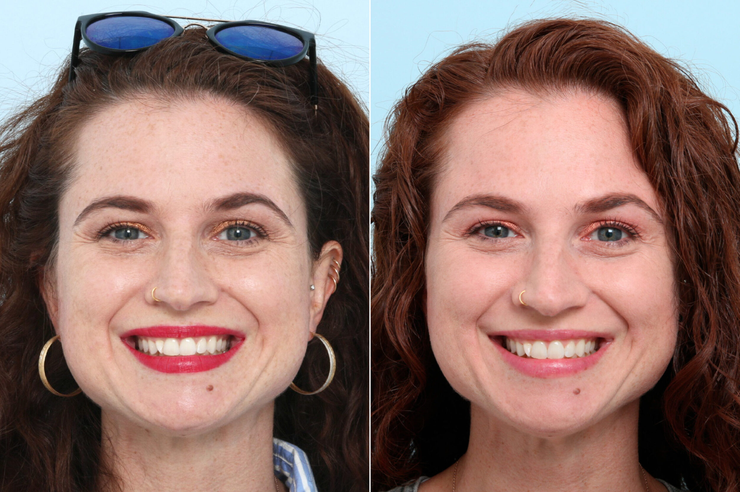 Before and After Image: Botox® Cosmetic & Xeomin Before and After Photos in Houston, TX, Patient 10367 - front
