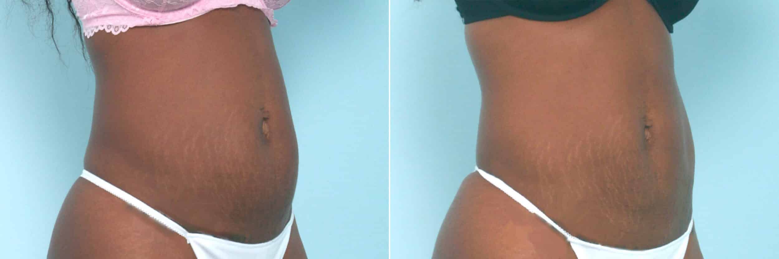 Before and After Image: CoolSculpting Before and After Photos in Houston, TX, Patient 10539 - right-front-oblique