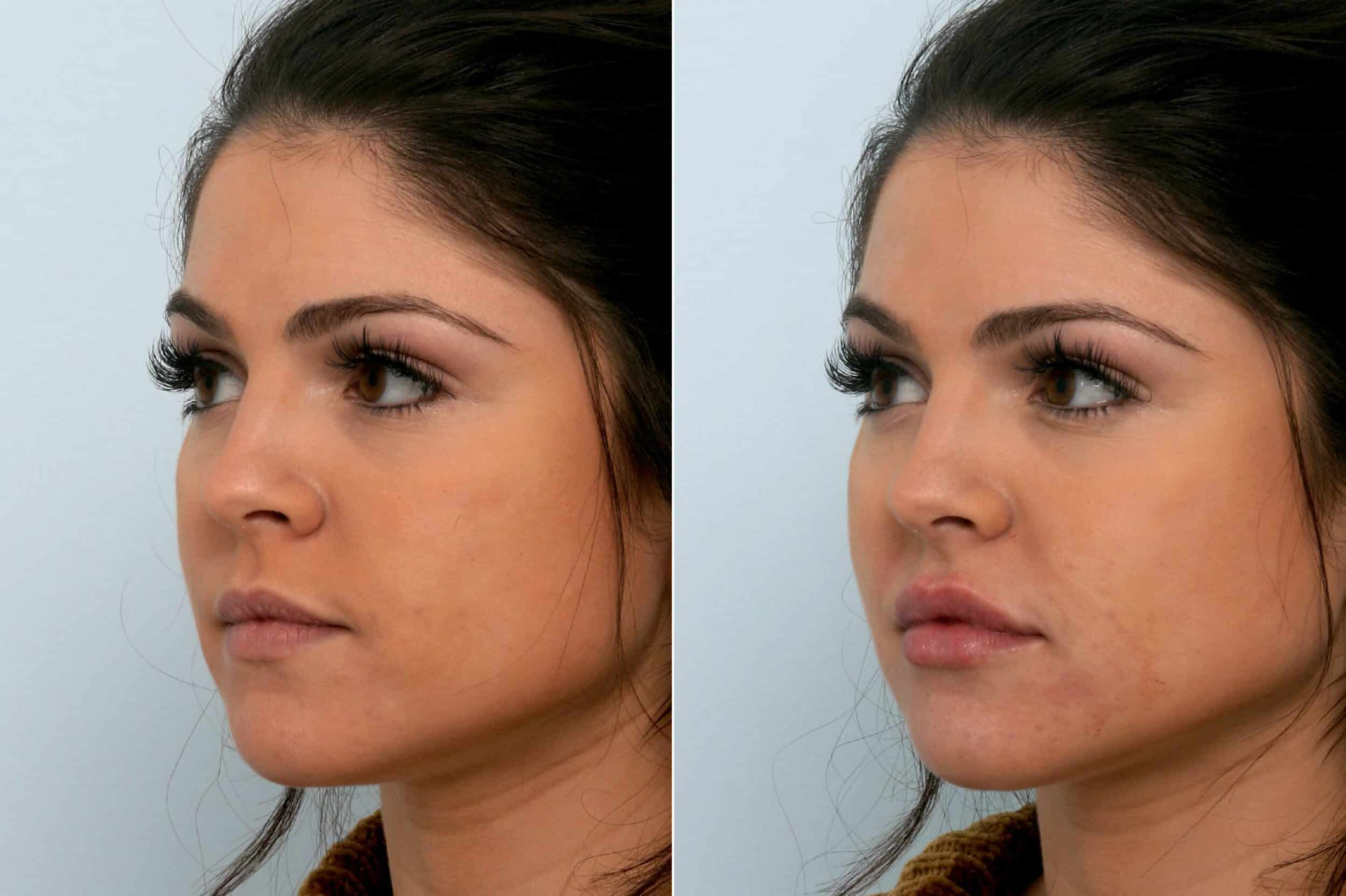 Before and After Image: Fillers Before and After Photos in Houston, TX, Patient 10755 - left-front-oblique