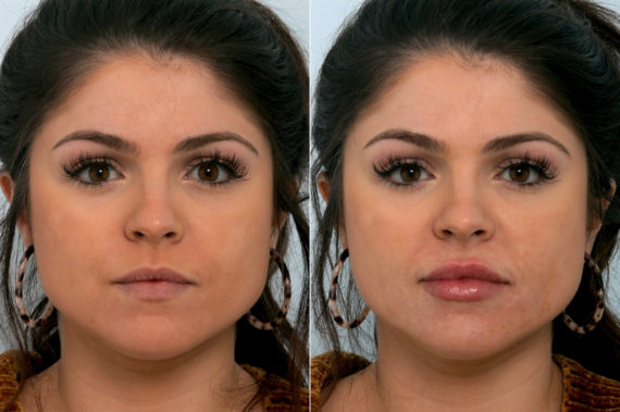 patient 10755 juvederm injectable gel before after 570x379
