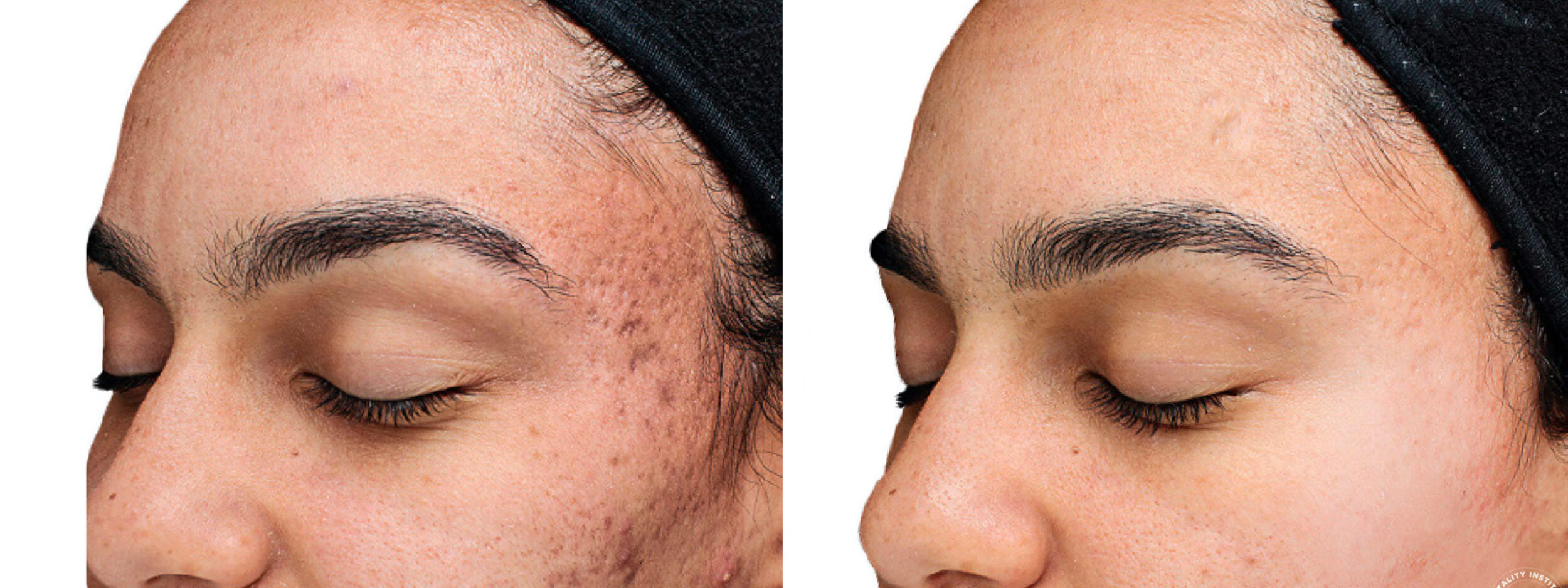 Before and After Image: Chemical Peels Before and After Photos in Houston, TX, Patient 10781 - left-front-oblique