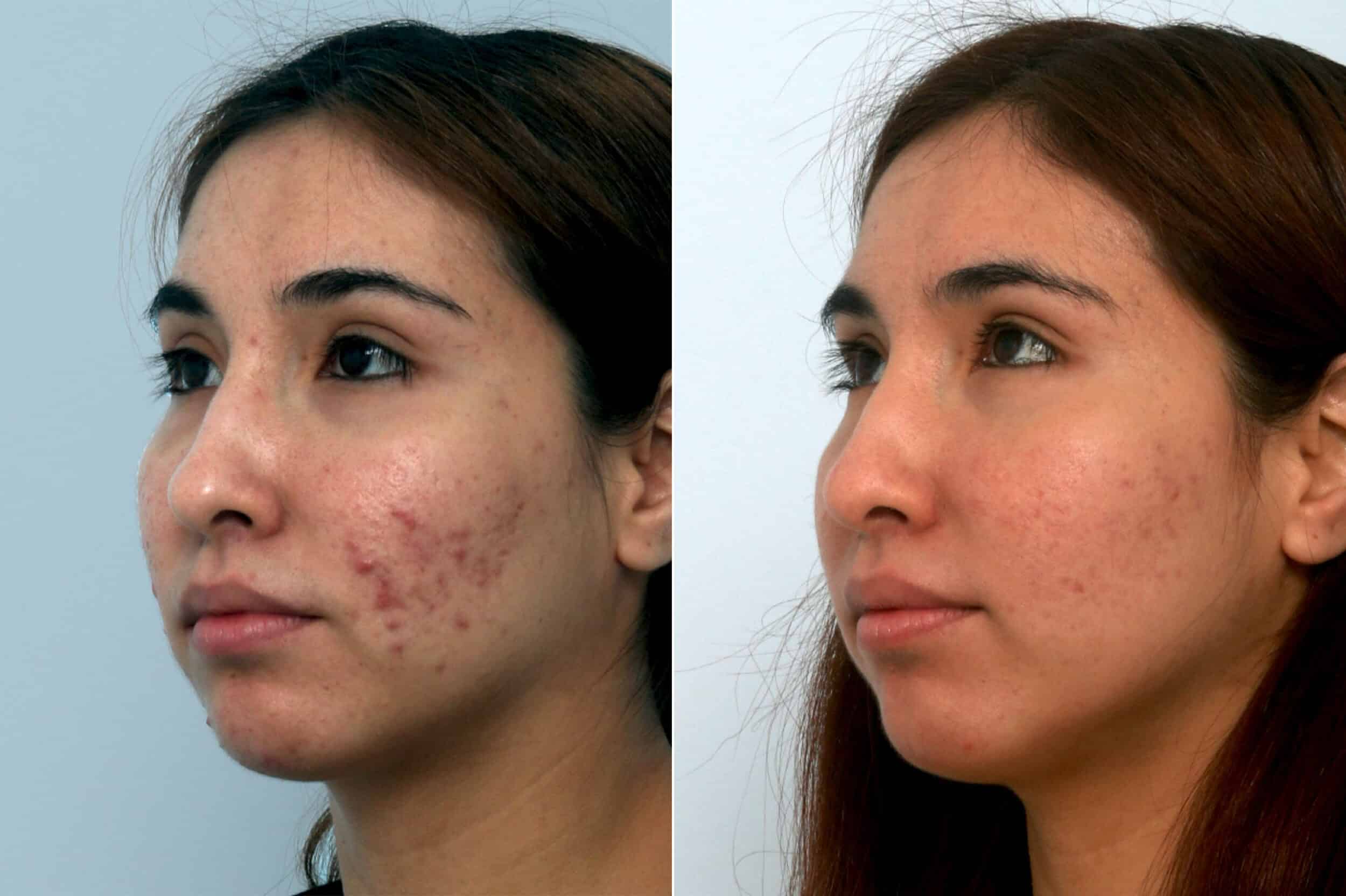 Before and After Image: Fraxel Laser Before and After Photos in Houston, TX, Patient 10943 - left-front-oblique
