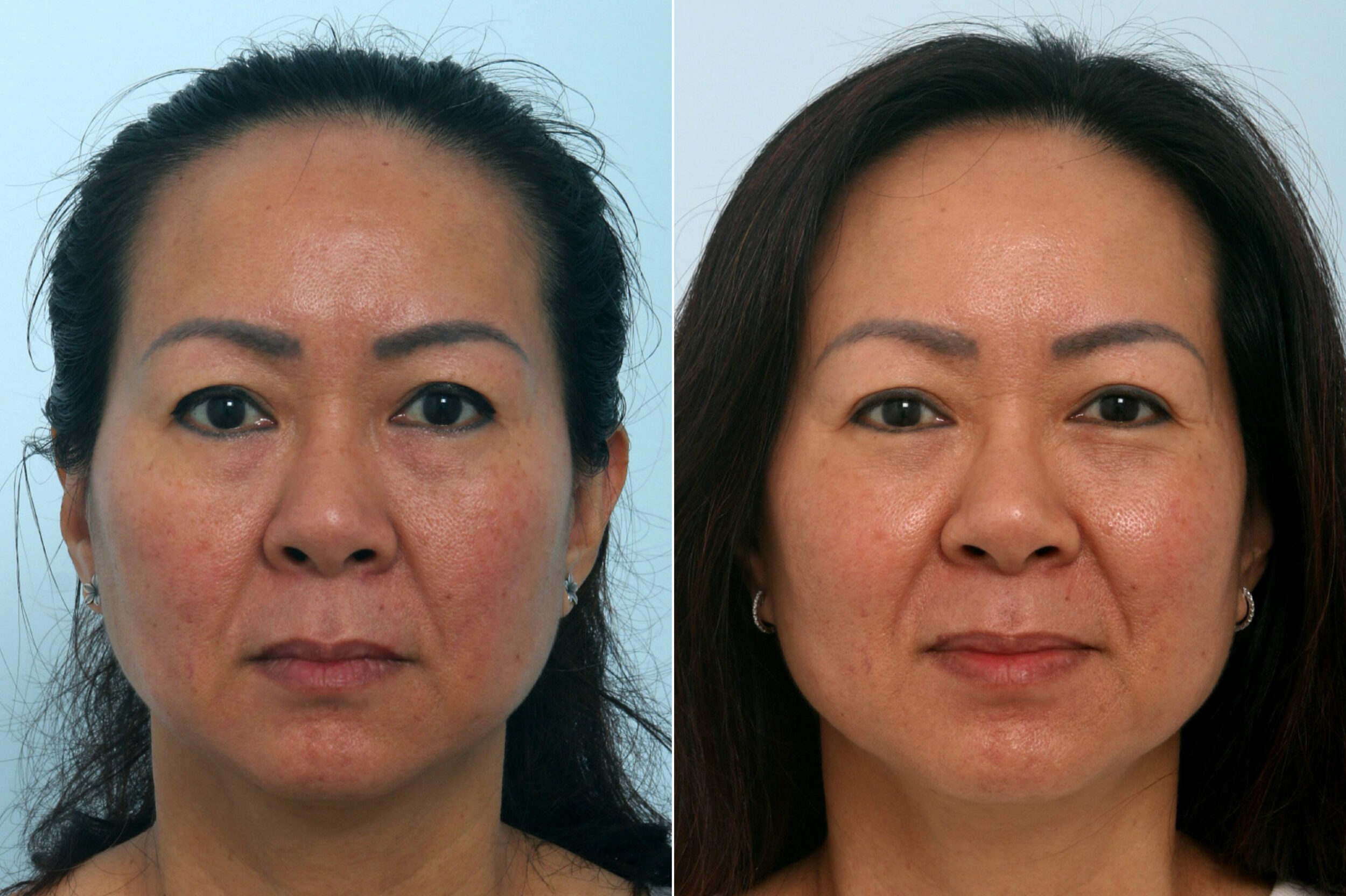 Before and After Image: Fraxel Laser Before and After Photos in Houston, TX, Patient 10961 - front