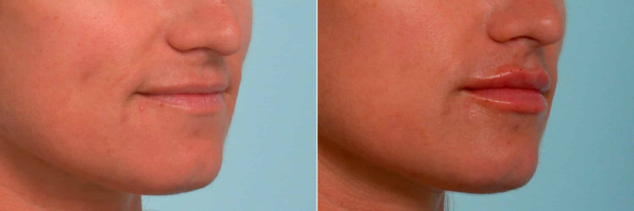 Before and After Image: Lip Enhancement Before and After Photos in Houston, TX, Patient 11384 - right-front-oblique